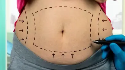 mitos e verdades sobre a lipoaspiração