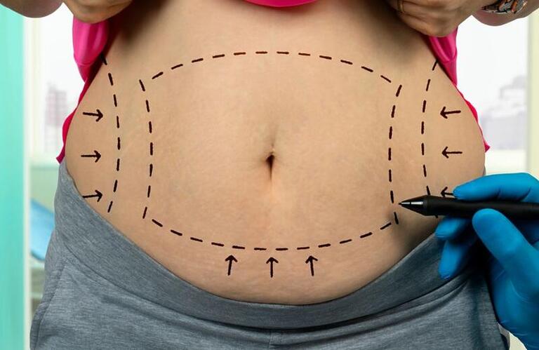 Mitos e verdades sobre a lipoaspiração