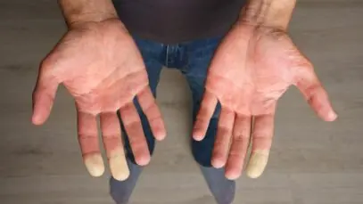 fenômeno de raynaud