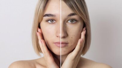 Uma em cada quatro mulheres têm acne na vida adulta