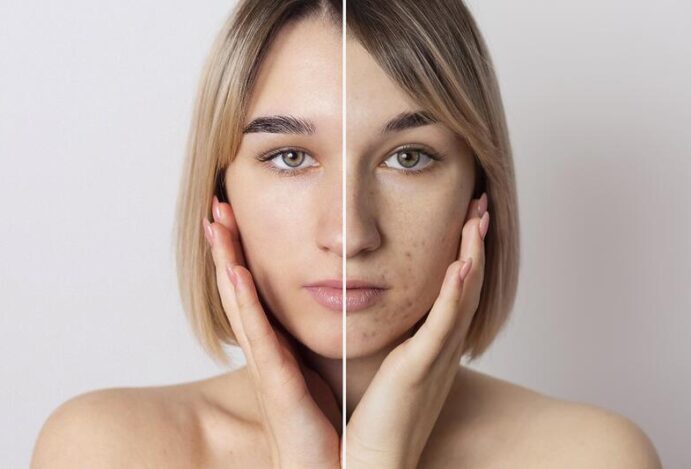 Imagem relacionada a: Uma em cada quatro mulheres têm acne na vida adulta