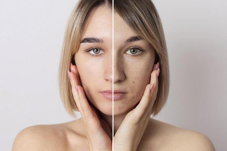 Uma em cada quatro mulheres têm acne na vida adulta