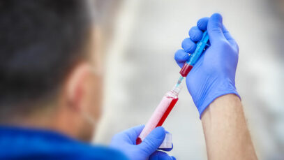 Teste pode facilitar o tratamento da esclerose múltipla