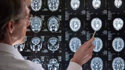 Medicamento da Lilly contra Alzheimer chega ao Brasil em breve