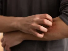 Ver mais: Farmacêutica seguirá fornecendo tratamento gratuito contra a hanseníase por meio de parceria com a OMS